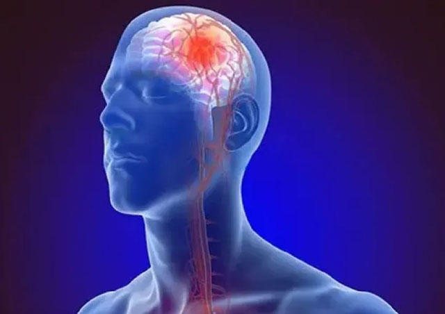 Rising stroke burden demands urgent global action