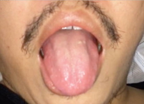 MRI scans of tongue may help detect motor neurone disease early, says study